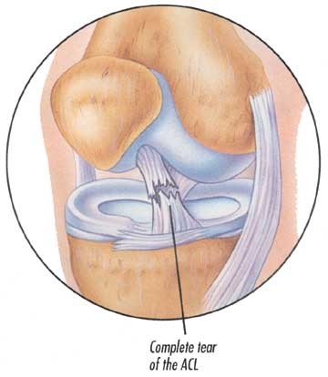 Acl Tear Images