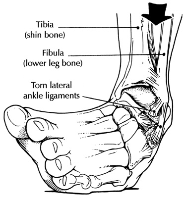 Types Of Sprains